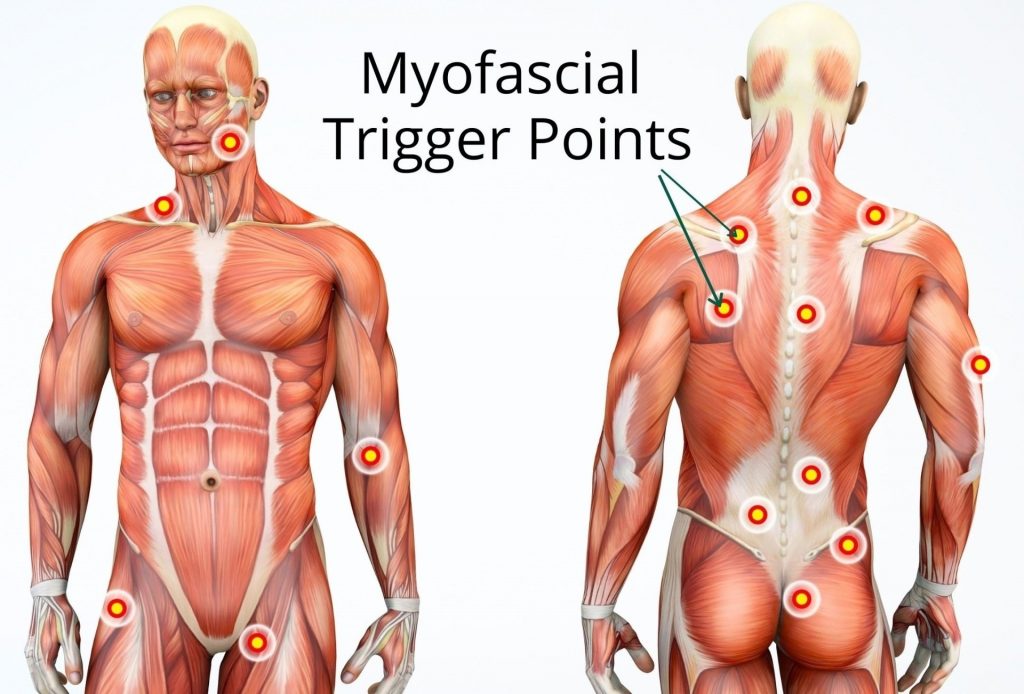 Trigger Points - Myofascial Relases