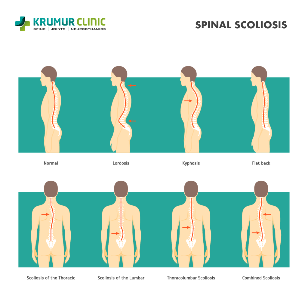 Spine Scoliosis