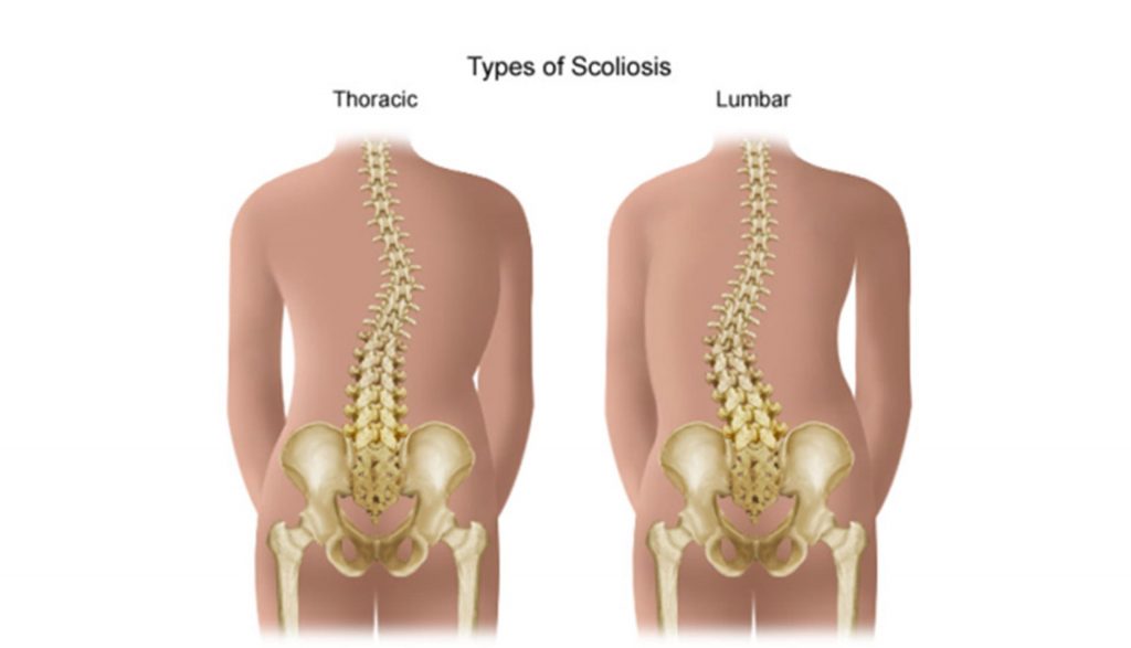 Scoliosis - Types